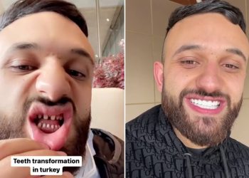 Turkey Teeth gone wrong