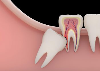 Wisdom tooth extraction