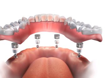 all on 4 plus dental implants