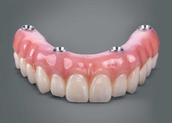 all on four dental implants