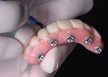 all-on-four dental implants