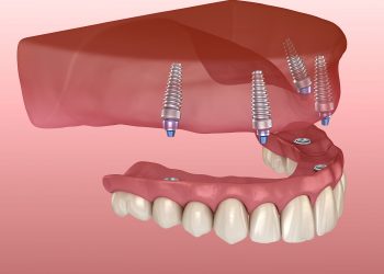 all-on-four teeth replacement