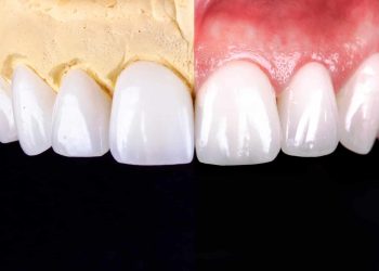 composite veneers