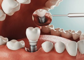 dental implants Turkey teeth