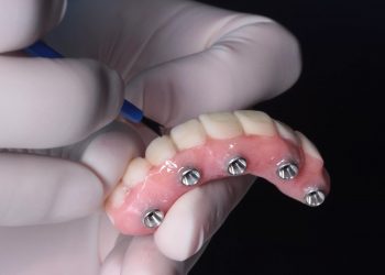 future of dentistry all on four