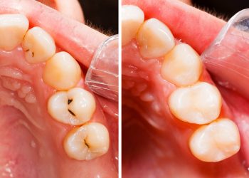 dental fillings technology